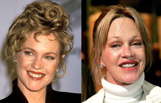 Melanie Griffith sejas ādas... Autors: UglyPrince Plastiskā ķirurģija