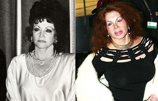 Jackie Stallone injekcijas... Autors: UglyPrince Plastiskā ķirurģija