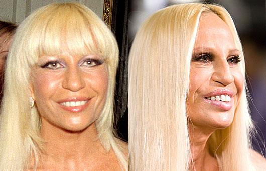 Donatella Versace lūpu... Autors: UglyPrince Plastiskā ķirurģija