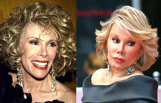 Joan Rivers Deguna korekcija... Autors: UglyPrince Plastiskā ķirurģija