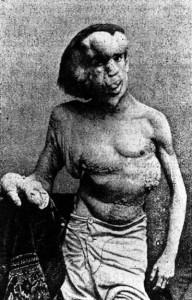 Joseph Merrick -slavenākais Elephant Man