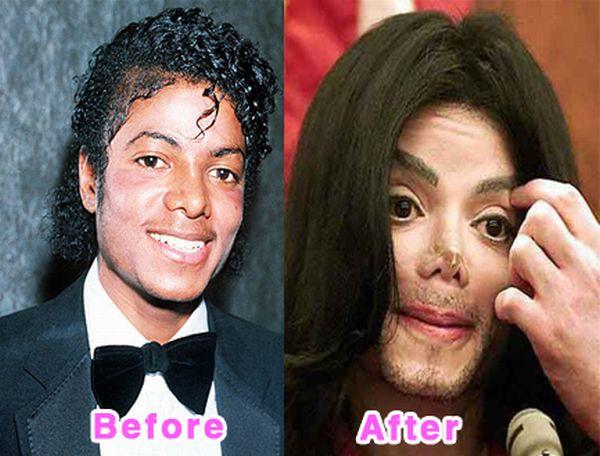Michael Jackson Autors: bee62 16 Worst Celebrity Plastic Surgery Disasters part 1
