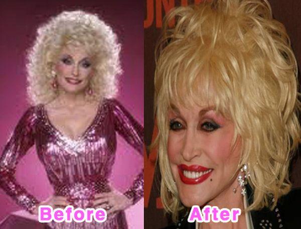 Dolly Parton Autors: bee62 16 Worst Celebrity Plastic Surgery Disasters part 1