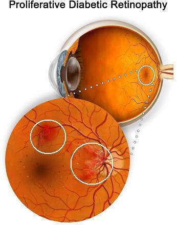 Diabētiskā retinopātija ir... Autors: roberts1144 Tīklenes patoloģija