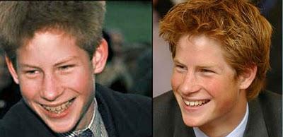 Prince Harry Autors: MJ Slavenību zobi pirms un pēc!