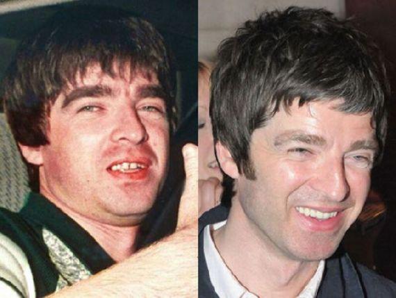 Noel Gallagher Autors: MJ Slavenību zobi pirms un pēc!