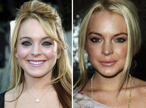 Lindsay Lohan palielināja... Autors: Simkiwi Slavenības, kuras nemanot veica plastiskās operācijas