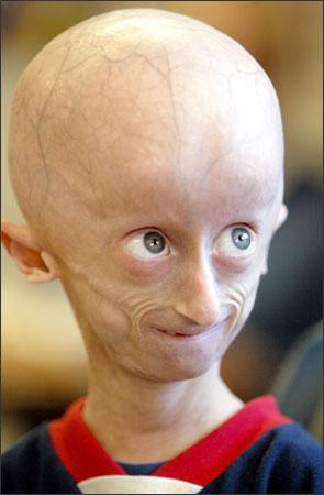 Progeria Scaronī ir fatāla... Autors: hate Slimības , kuras tu noteikti negribētu