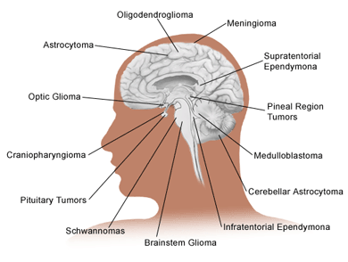 Ir vairāk nekā 126 smadzeņu... Autors: InXx Smadzeņu audzējs