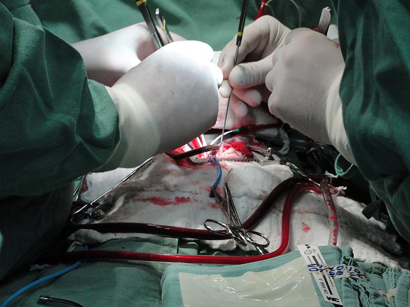 Atklāta sirds operācija  ... Autors: Colonel Meow Top 10 pašas dārgākās medicīniskās procedūras.