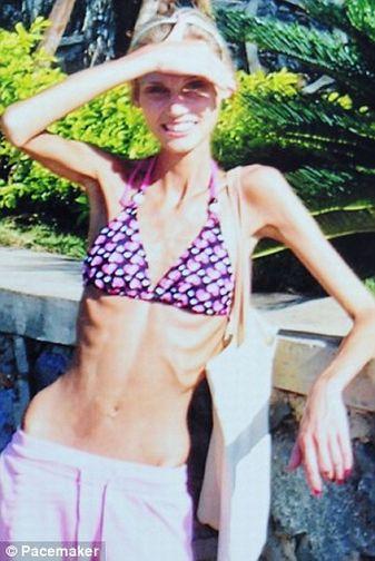  Autors: ORGAZMO es pārvarēju anoreksiju.