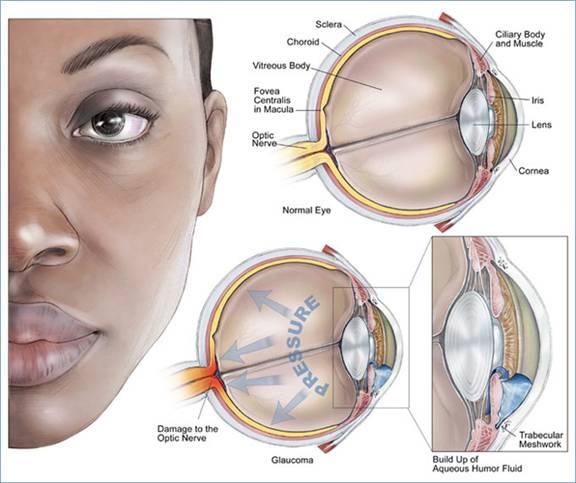 Glaukoma nav izārstējama... Autors: bubina696 Dažas izplatītākās acu slimības