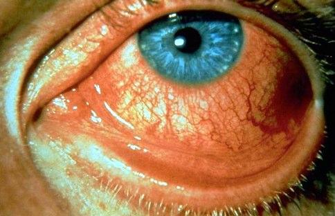 Iekaisums vai infekcija acs... Autors: bubina696 Dažas izplatītākās acu slimības