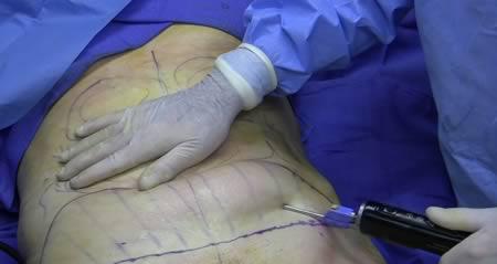 Neveiksmīga kāju operācija17... Autors: AldisTheGreat Pasaulē Pirmās Plastiskās Operācijas.