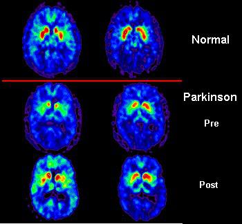 Parkinsona slimība ir... Autors: sendijazzz 3 Slimības par kurām tu tagad izglītosies.