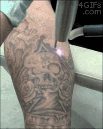 Scaronādi noņem tetovējumu Ja... Autors: Garais Burkāns Kā Tas Strādā? #3