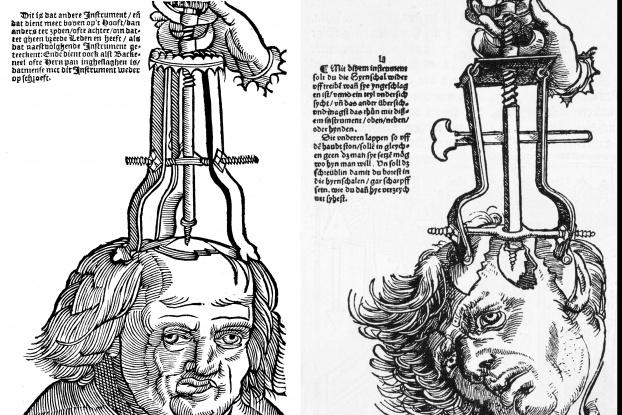 TrepanācijanbspRupji runājot... Autors: Prāta Darbnīca Dīvainākie ārstēšanas paņēmieni, ko kādreiz izmantoja (2.daļa)