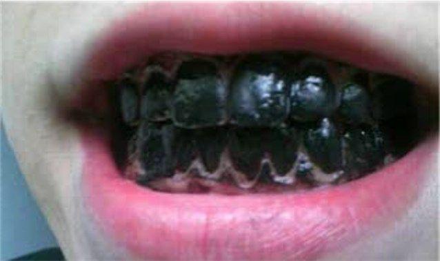 Mūsdienās vēl aizvien notiekās... Autors: misawesome Fakti par zobiem.