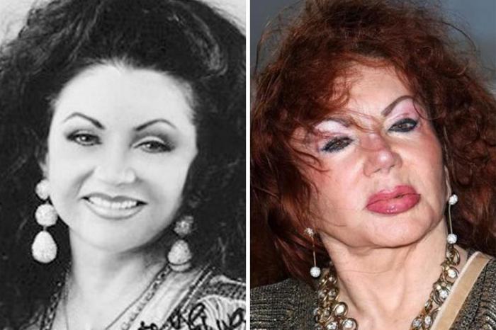 Žaklīna Stalone Autors: Volāns Sievietes pirms un pēc plastiskās operācijas
