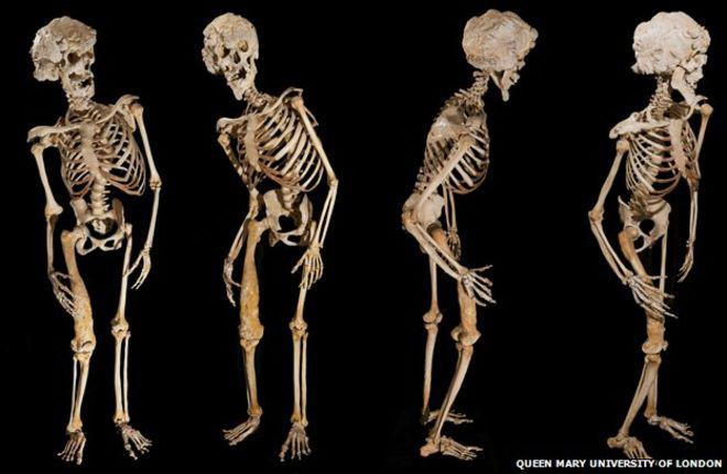 Džozefs Kerijs Merriks... Autors: The Diāna Izglītojoši: Neparasti skeleti, kuri ilustrē slimības un procesus