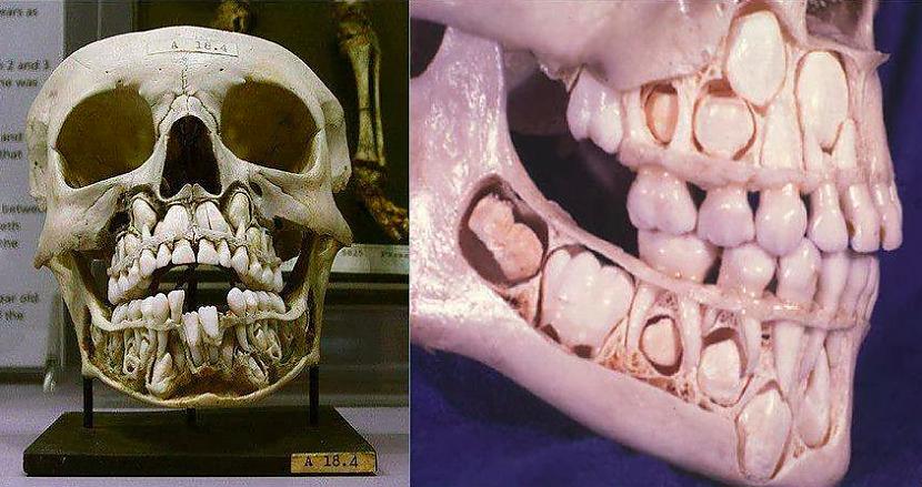 Galvaskauss ar piena zobiem un... Autors: The Diāna Izglītojoši: Neparasti skeleti, kuri ilustrē slimības un procesus