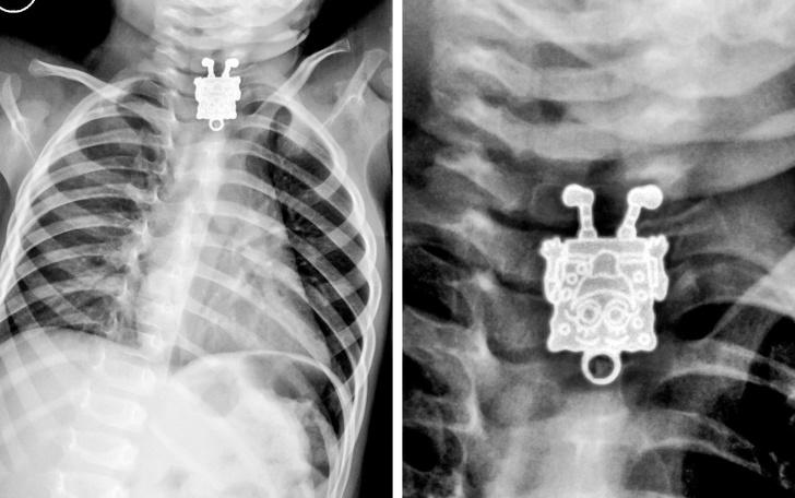 16 mēnescaronus vecs bērns... Autors: Lestets 15 rentgenuzņēmumi, kas atklās par ķermeni vairāk nekā anatomijas grāmatas