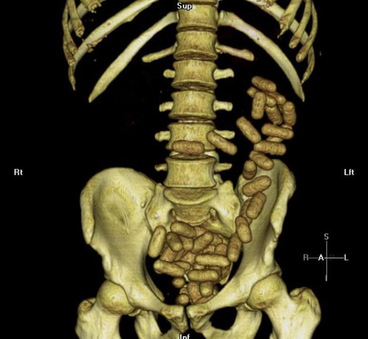 Tā izskatās quotnarkomūļaquot... Autors: Lestets 15 rentgenuzņēmumi, kas atklās par ķermeni vairāk nekā anatomijas grāmatas